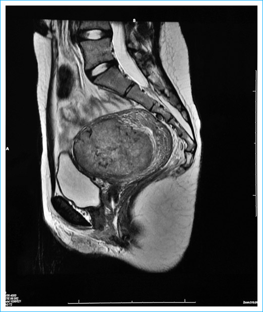 Uterine Fibroid in enlarged uterus