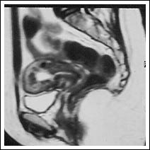 At 5th October 1999 - post embolisation showing virtually normal uterus. This was followed by a successful pregnancy.