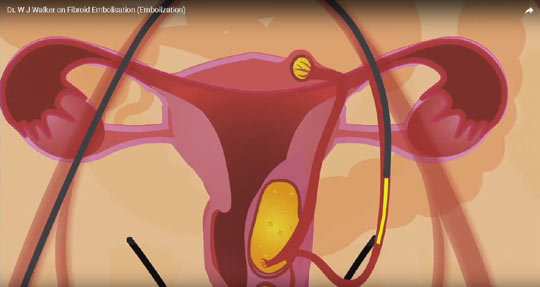 Dr. Walker uterine fibroids